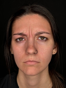 Tori Atkins RN. Treated with Xeomin.-before