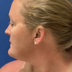 Lipo w Skin Tightening Face #7-before