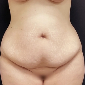 Tummy Tuck #7-before