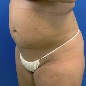 Lipo w Renuvion #3-after