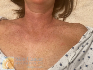 After 1 treatment-after