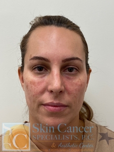 Under Eye Rejuvenation and IPL-before