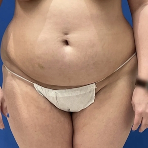 Lipo w Renuvion #2-before