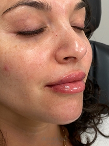 Whitney Devall RN.-after