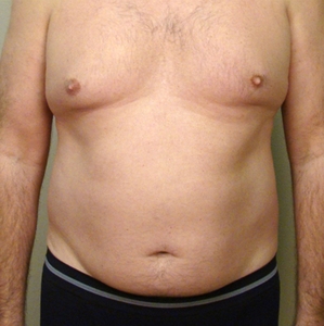 Liposuction #3-before