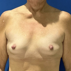 Breast Augmentation #5 350 cc-before