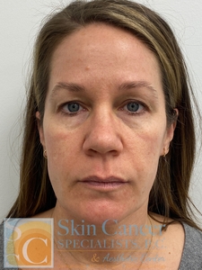 IPL and Botox-before