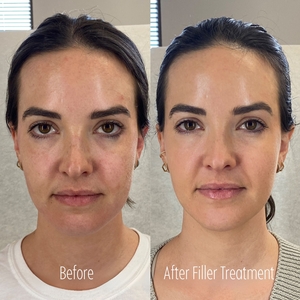 Filler B/A SBA 25-before