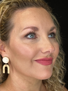 174 Units of Dysport in Crow's Feet and Forehead-after