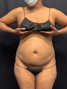 Lipo 360 + mini tummy tuck-after