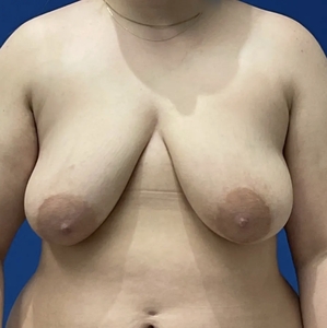 Breast Lift #5-before