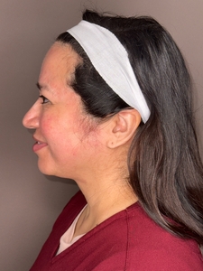 Irmalinda Garcia- Emface Sub/Cheeks-after