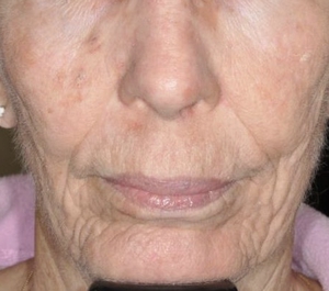 Actinic Keratosis, Lentigines & Wrinkles-after