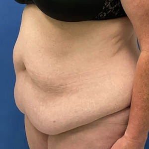 Tummy Tuck #1-before