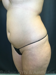 plus lipo 2.0-before