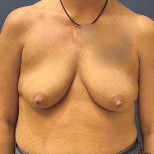 Breast Augmentation #4 450 cc-before