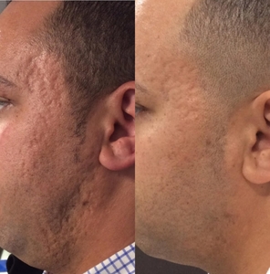 Microneedling-before