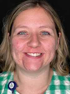 Trisha Sheehan LME. - DDAcne-before