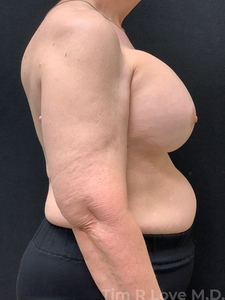 Implant Exchange-before