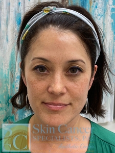 IPL Face 1 Treatment-after