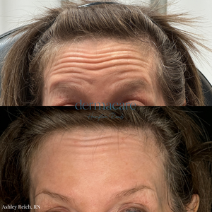 Ashley Reich RN. Botox-before