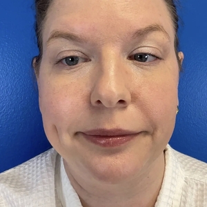 Lipo w Skin Tightening Face #8-before