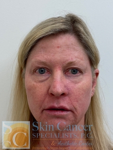 Nova Threads-neck, cheeks and around mouth-before