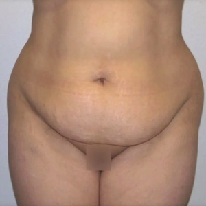 Mommy Makeover #3-before