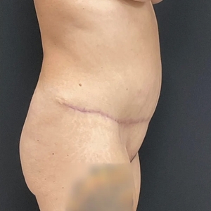 Tummy Tuck #11-after
