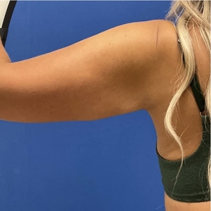 Lipo w Renuvion #11-after