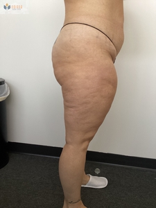 2 Butt Lift Treatments-before