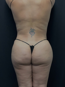 LAL-BBR + BBL-before