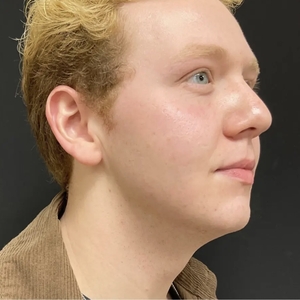 Lipo w Skin Tightening Face #6-after