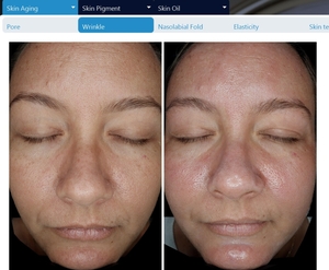 Before & After Hydroglow-before