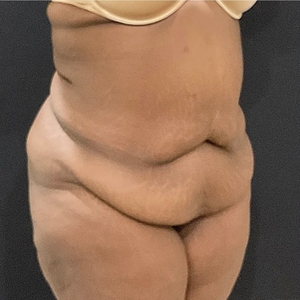 Tummy Tuck #4-before