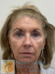 Cheek Filler, Around Mouth Filler and Botox-before