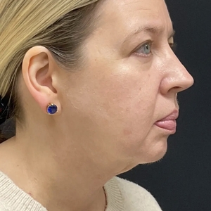 Lipo w Skin Tightening Face #3-after