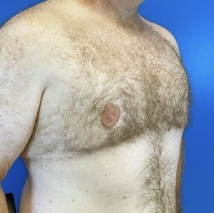 Male Breast Reduction #3 (right oblique)-after
