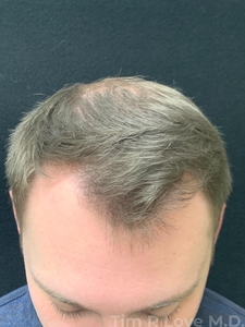 27 year old male after 1 year on Finasteride, no transplant needed-after