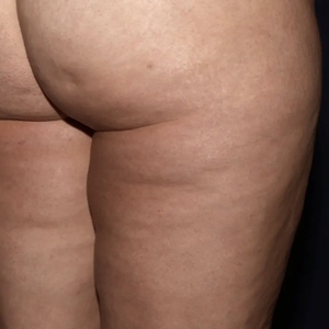 Cellulite Reduction #3-after