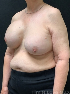 Implant Exchange-before