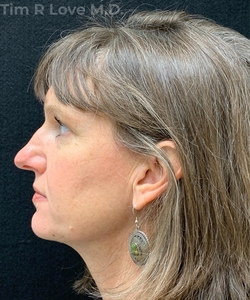 Rhinoplasty - Traditional-before