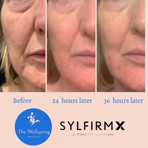 Pre and Post Procedure-before