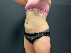 Compare-after