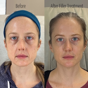 Filler B/A SBA 3-before