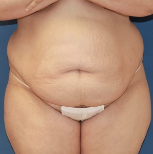 Tummy Tuck #9 (front)-before