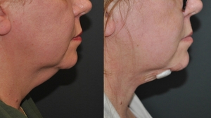 Before and After FaceTite & Liposuction at 12 days-before
