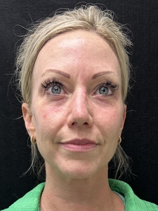 1 syringe of Volbella-before