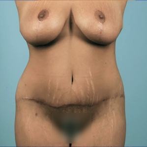 Mommy Makeover #4-after