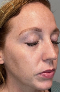 Laser skin resurfacing at Yuva-after